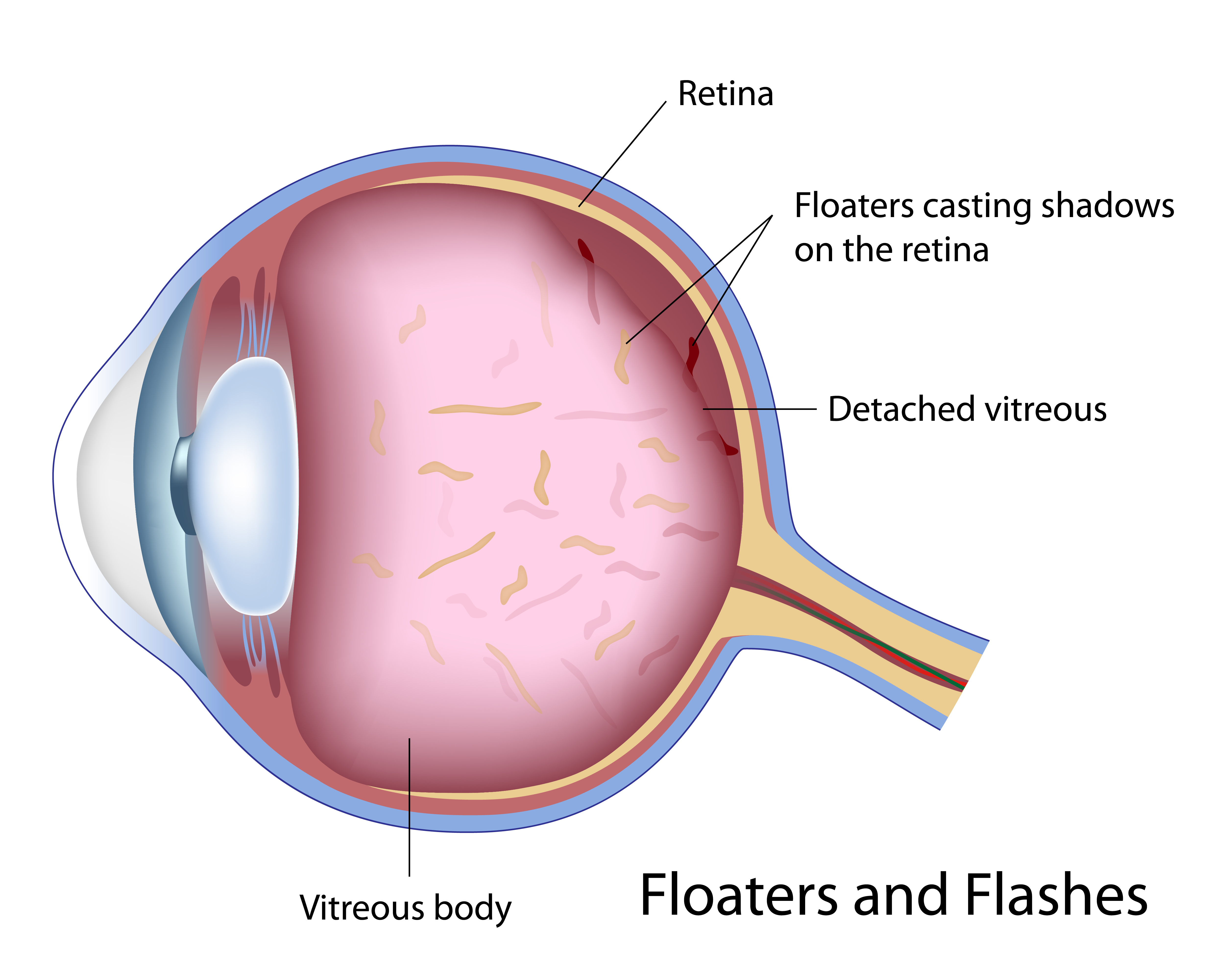 Eye floaters and flashes