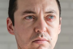 Chalazion Infection