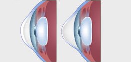 Keratoconus Treatment