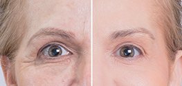 Thermage Skin Tightening Treatment