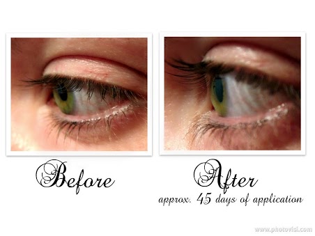 Before And After Latisse® Eyelash Treatment