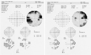 Glaucoma Imaging