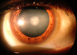 Corneal Abrasion Treatment