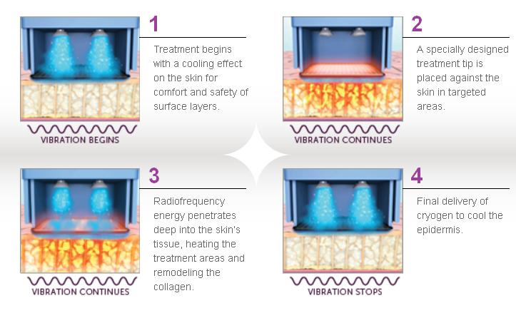 Thermage Skin Tightening Procedure