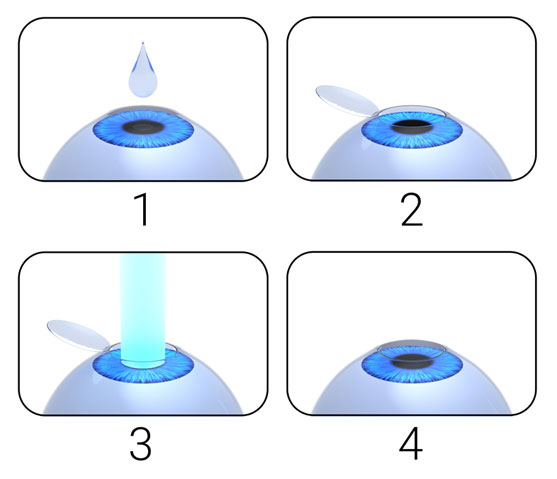 LASIK procedure Toronto