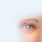 CATARACT-SURGERY