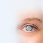 Cataract-Surgery